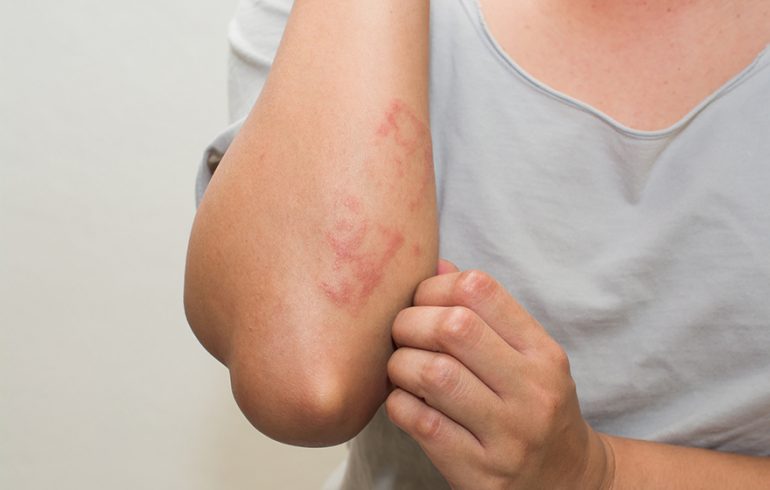 Eczema: qué es, tratamiento, causas y tipos